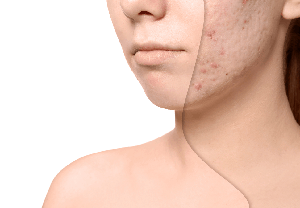 acne scar removal