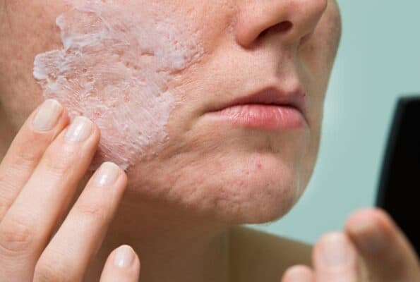 salicylic acid acne treatment
