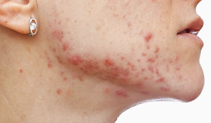 treat fungal acne